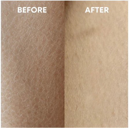 Before and after: rough patches and ingrown hairs look smoother after exfoliating