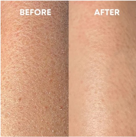 Before and after: dry, flaky skin looks smoother after exfoliating