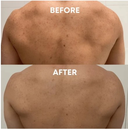 Before and after: back breakouts and dark marks look improved after exfoliating