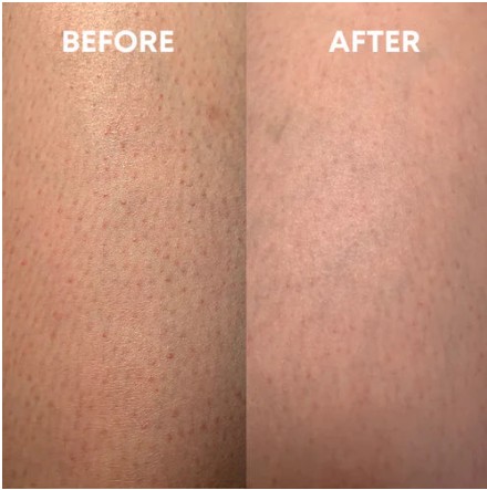 Before and after: keratosis pilaris bumps look reduced after exfoliating